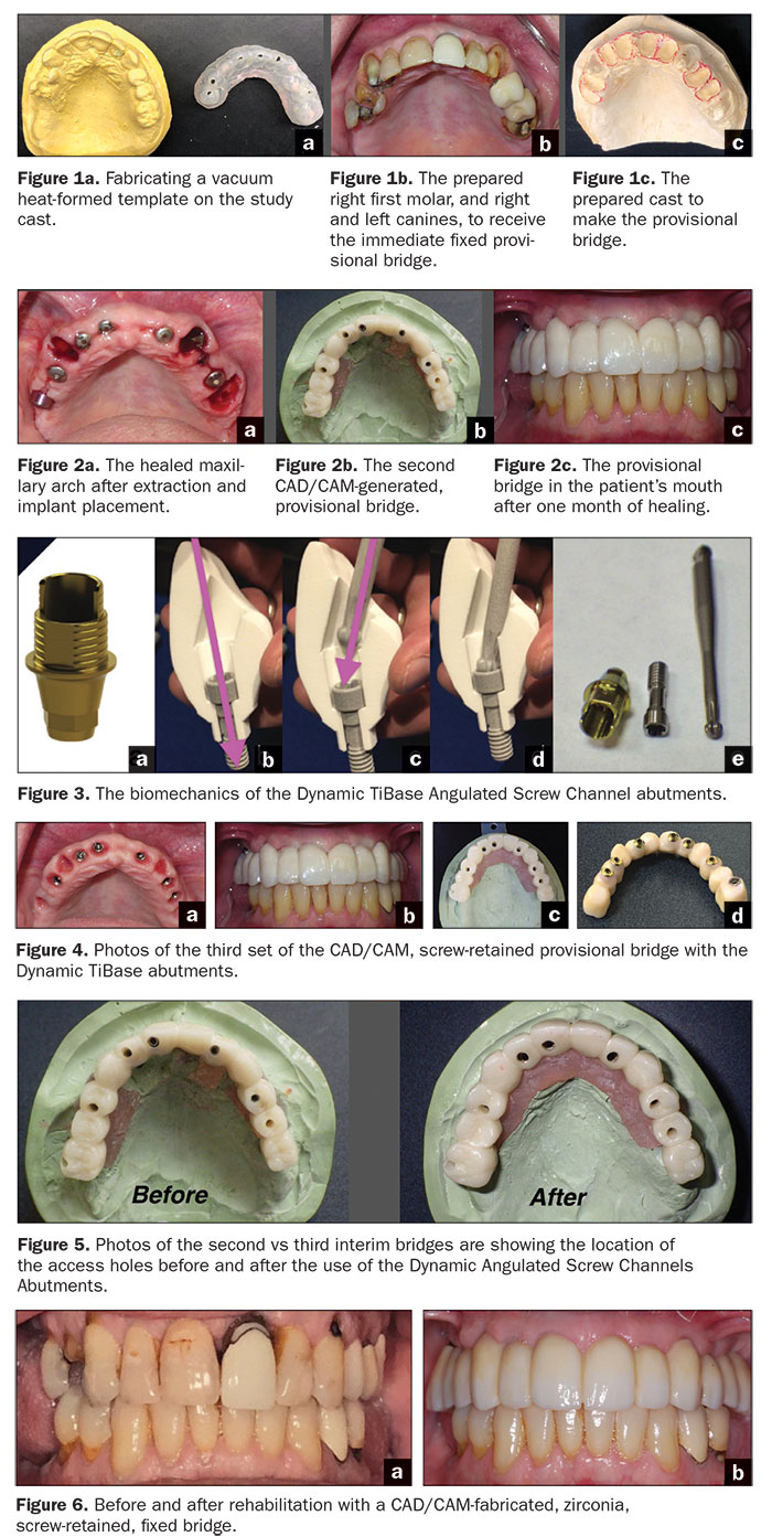 Dental Bridge Abutment