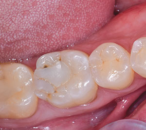 A Successful One-Appointment Monolithic Restoration – Dentistry Today