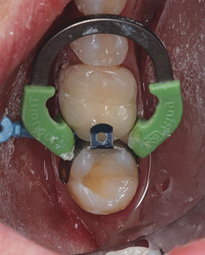 The 3S PowerCure System: Rethinking Direct Resin Restorations From the ...