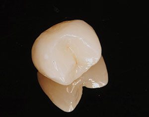 Zirconia is Special: The Optimal Procedure for Zirconia Bonding ...