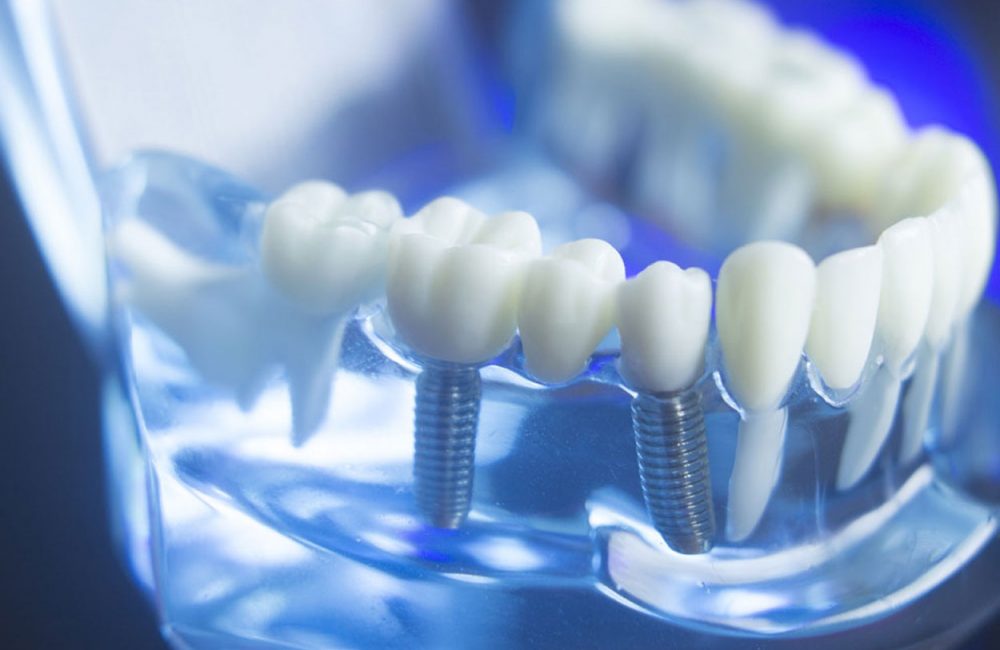 Variations in Dental Implant Applications - Dentistry Today