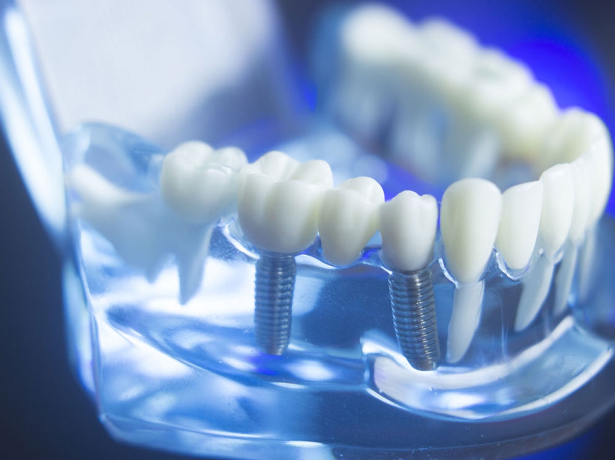 Variations in Dental Implant Applications - Dentistry Today