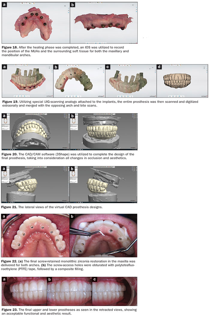 Full-Arch Implant Surgical And Restorative Considerations: Innovative ...