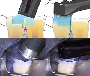 Dental curing light - Wikipedia