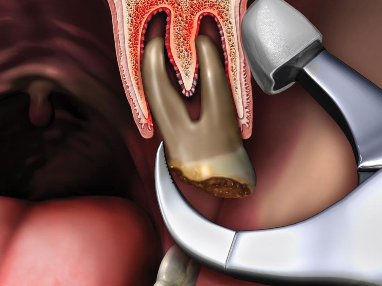 Image of a dry socket in the region of the maxillary left second