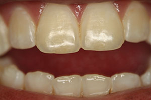 MI Paste Plus - Mint Reverses White Spots In Teeth - With Fluoride 