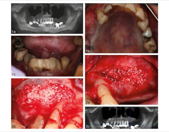 Courtesy of the Journal of Oral Implantology.