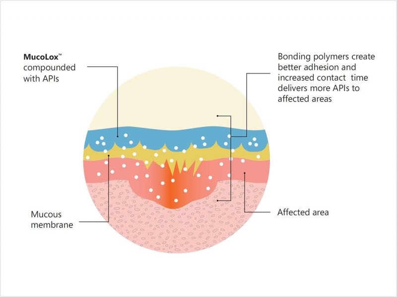 Drug Delivery System Improves Oral Lichen Planus Treatment - Dentistry ...