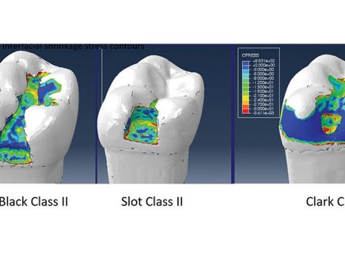 Introducing the Clark Class II Restoration - Dentistry Today