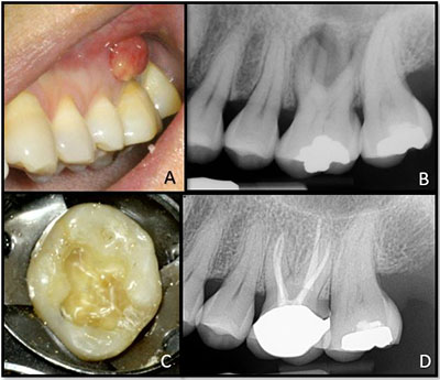Cracked Teeth Are Worth Saving: A Look at New Management Protocols