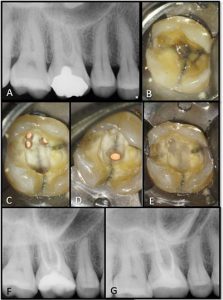 Cracked Teeth Are Worth Saving: A Look at New Management Protocols and ...