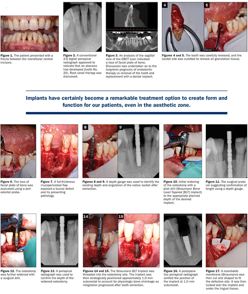 Explant / Dental Implant Removal - Leading Implant Centers