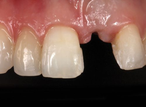 Implants Today | Dentistry Today