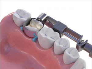 PinkBand Dental Solutions Matrix Band - Dentistry Today