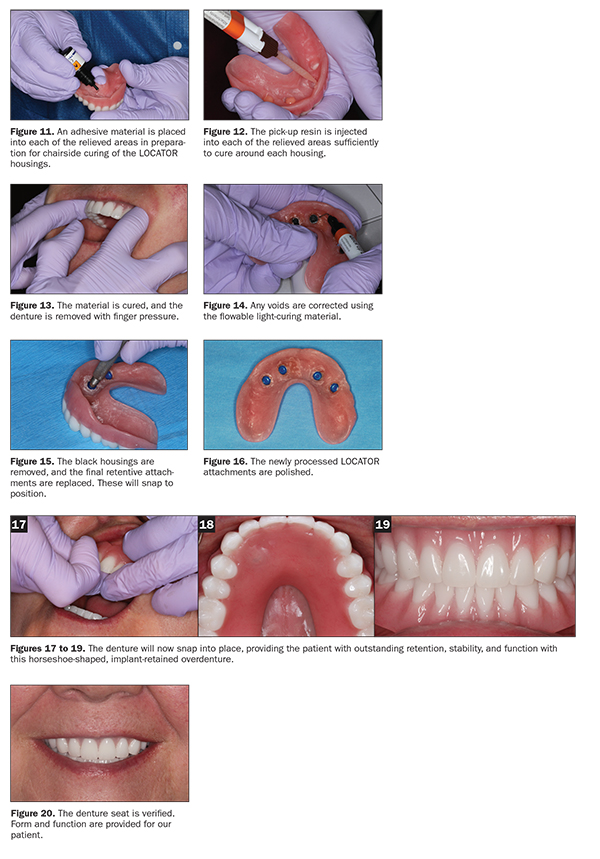 Attachment Selection for Implant-Supported Overdentures - Decisions in  Dentistry