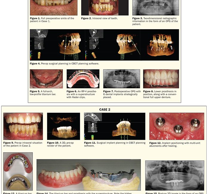 Personalized Dental Implant Solutions: One Size Fits None - Dentistry Today