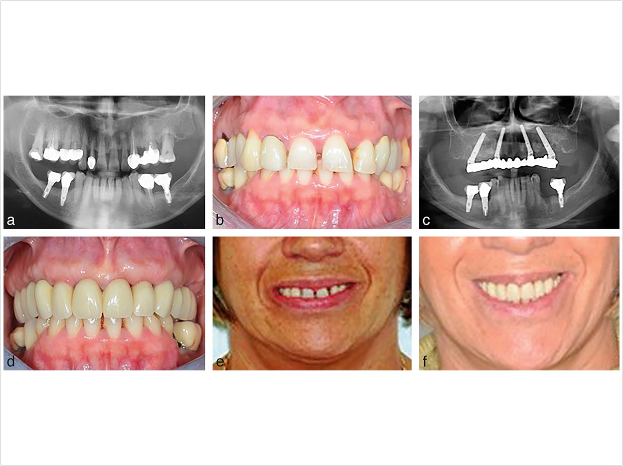 Courtesy of the Journal of Oral Implantology