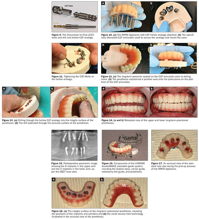 Continued Innovation For Full-Arch Immediate Loading: Small Access Hole ...