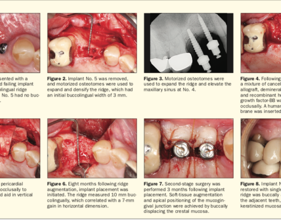 maxillary implants