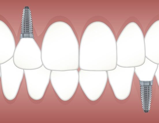 dental implants market