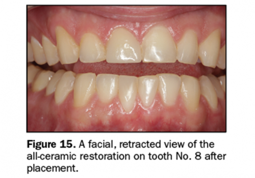 Seven Signs and Symptoms of Occlusal Disease: The Key to an Easy