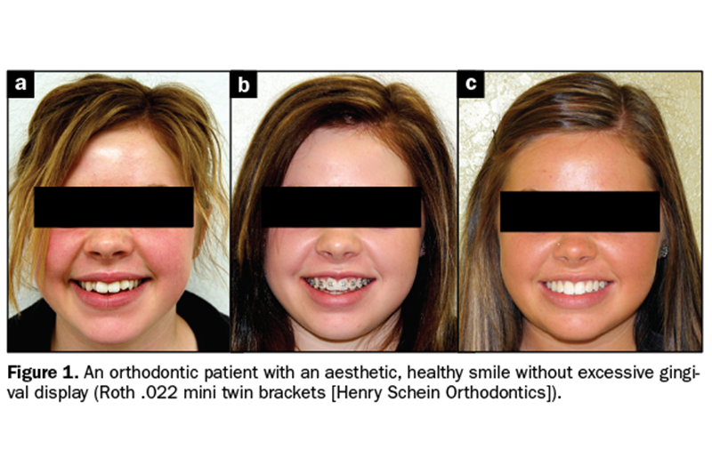 Oral Care During Orthodontic Treatment
