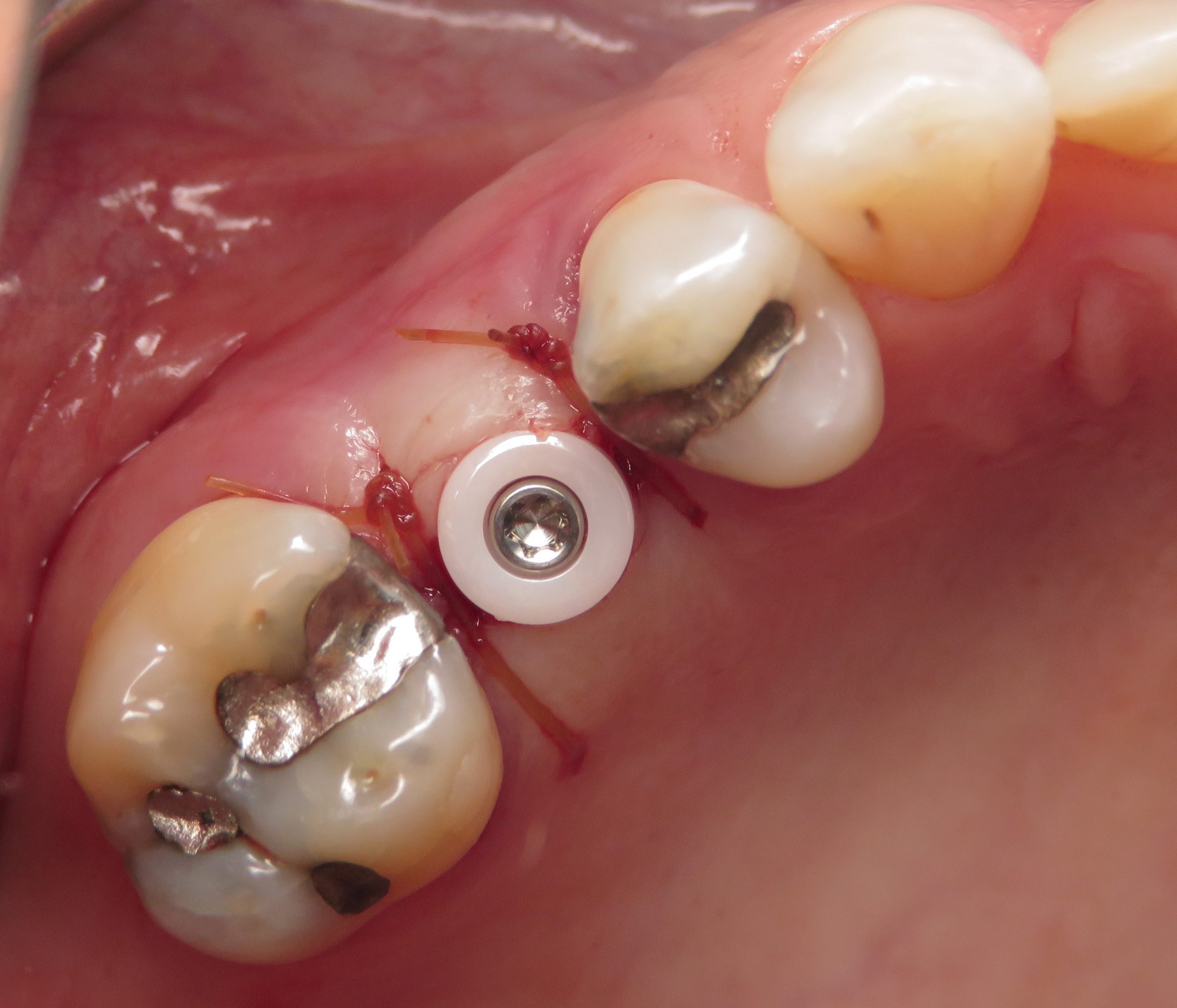 ceramic dental implants