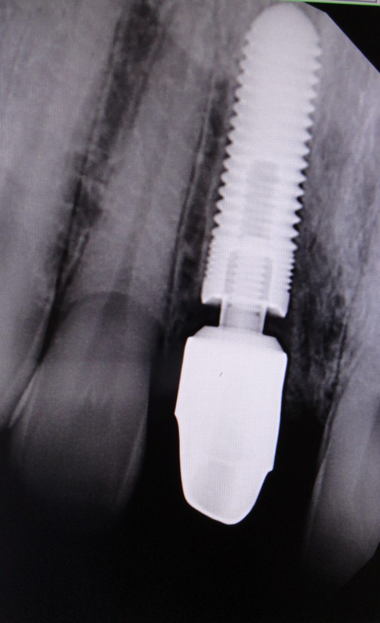 Immediate Implant Placement And Provisionalization For Type II Sockets ...