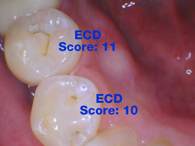Instant and Accurate Detection of Early Occlusal Caries - Dentistry Today