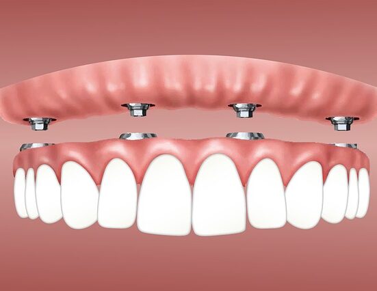 affordable dentures & implants