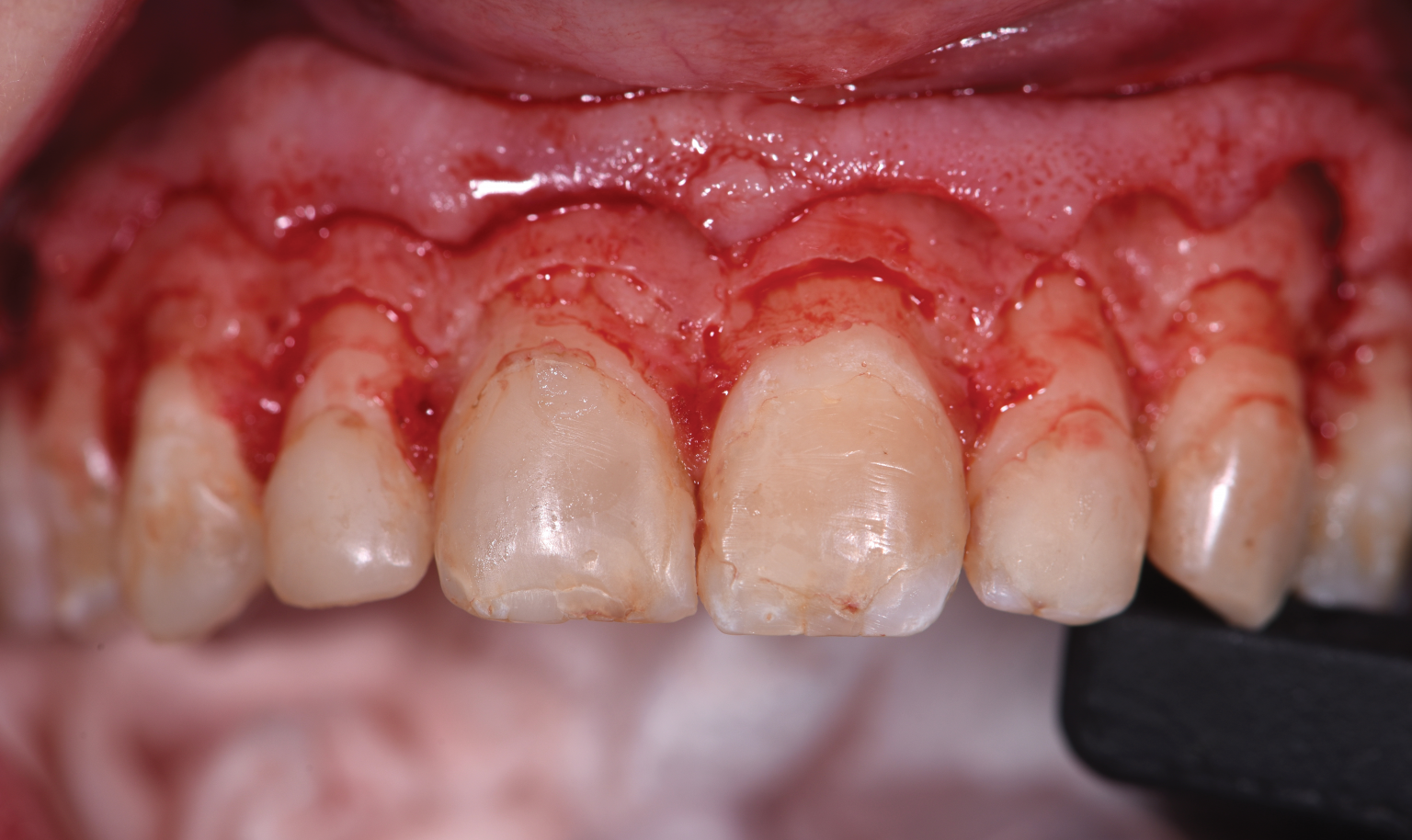 Aesthetic Crown Lengthening Utilizing A Digital Workflow - Dentistry Today