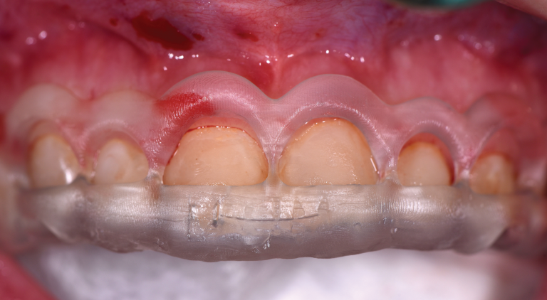 Aesthetic Crown Lengthening Utilizing A Digital Workflow - Dentistry Today