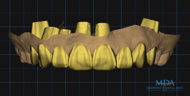 Aesthetic Crown Lengthening Utilizing A Digital Workflow - Dentistry Today