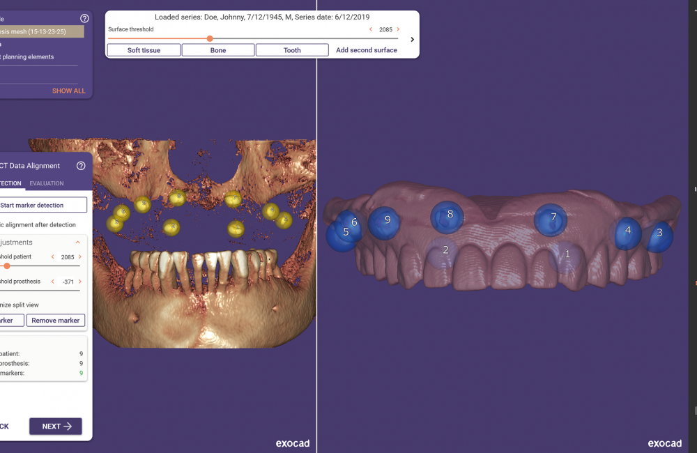 Exocad Releases Exoplan 3.0 Galway Software in the United States