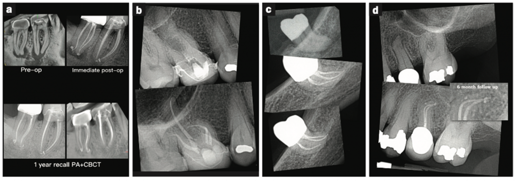 Instrumentation Errors: Tips and Tricks to Avoid It - Dentistry Today