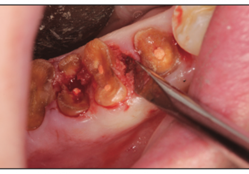 osteomyelitis jaw after wisdom teeth extraction