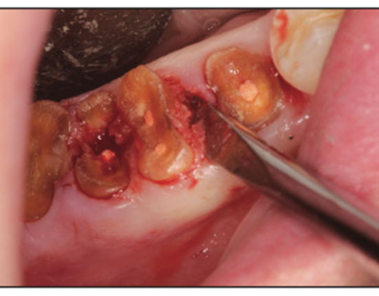 extraction complications