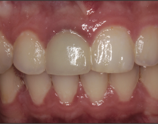 laser-assisted socket grafting