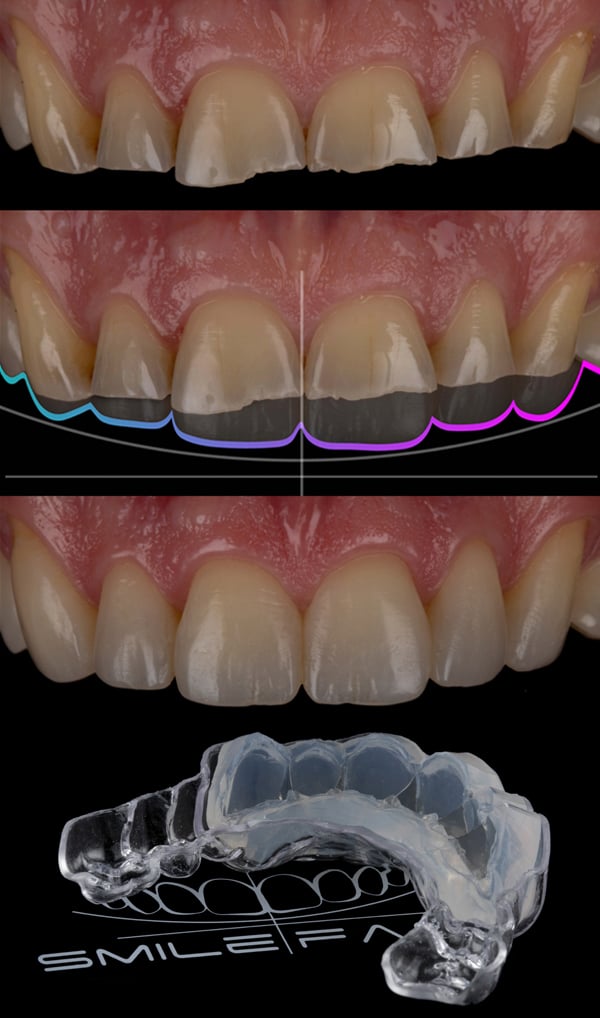 SmileFast - A Revolution in Direct Paste Resin Composite Veneers ...