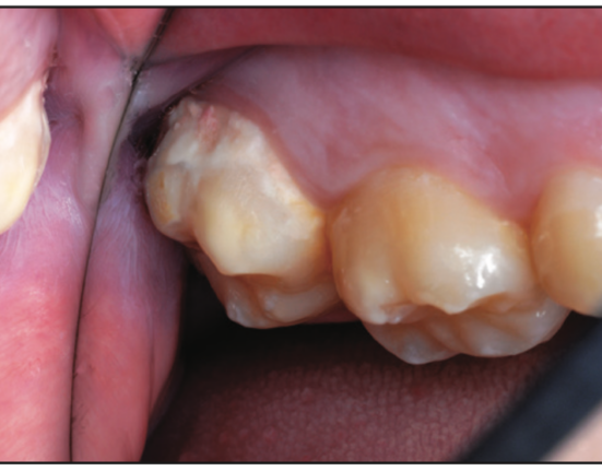 smooth-surface dental caries