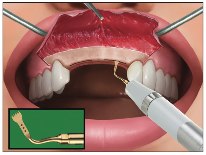 Ridge Expansion Osteotomy