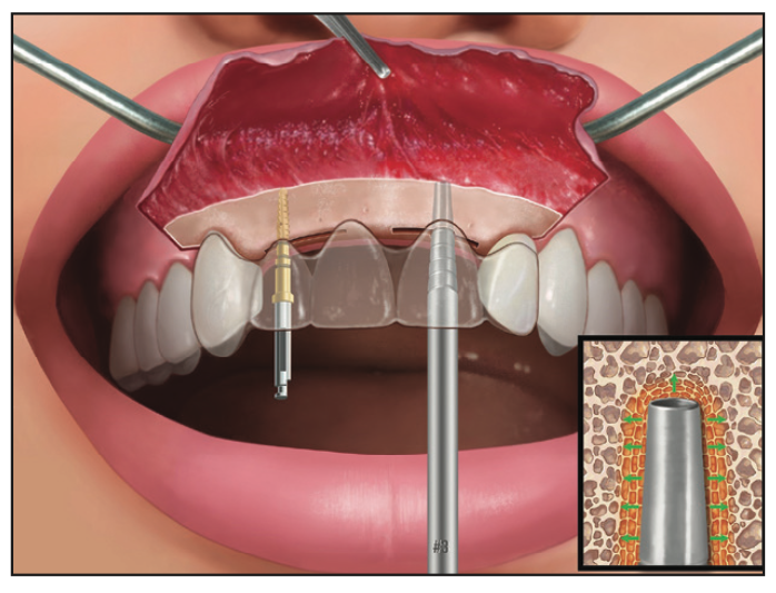 Ridge Expansion Osteotomy