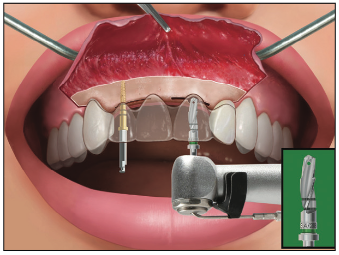 Ridge Expansion Osteotomy