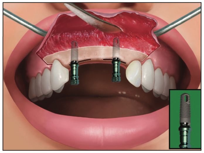 Ridge Expansion Osteotomy