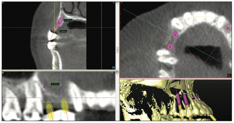 Ridge Expansion Osteotomy: A Combination Technique - Dentistry Today