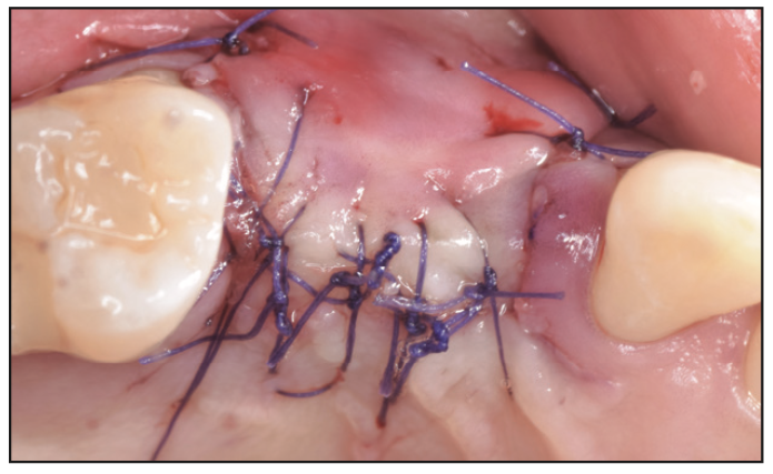 Ridge Expansion Osteotomy