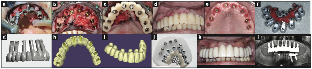 Fully Digital Full Arch? Continued Advancements In Full-Arch Implant ...