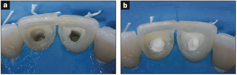 Direct Biomimetic Endodontic Access Restorations in Compromised Central ...