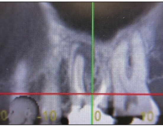 immediate implant placement