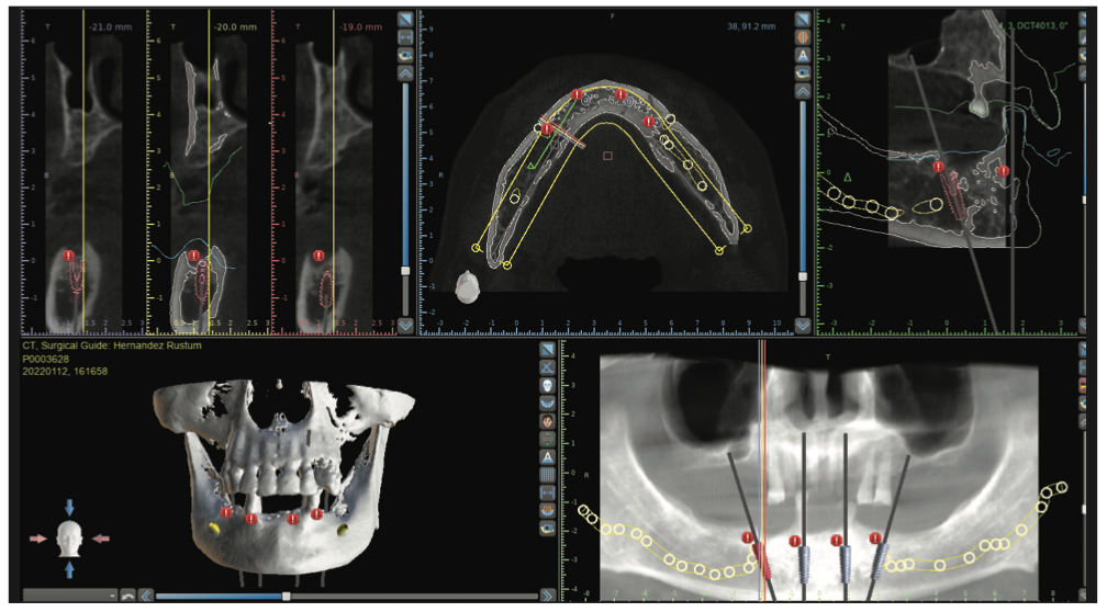 You can now digitally verify full-arch scans with Nexus Connect! The first  A.I enabled implant-scan alignment software. Full-arch scans…